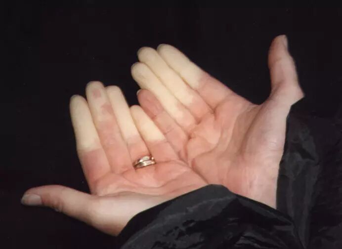 Photo des mains atteintes de la maladie de Raynaud